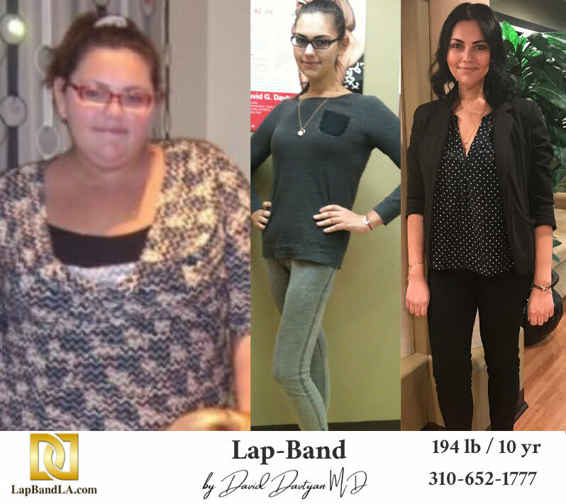 Bariatric Surgery - Before & After Weight Loss - Lap Band and Gastric Sleeve